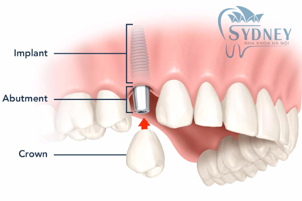 Cấy ghép răng bằng trụ implant