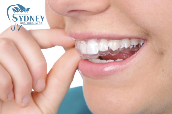 Thời gian niềng răng còn phụ thuộc vào mức độ răng của bạn