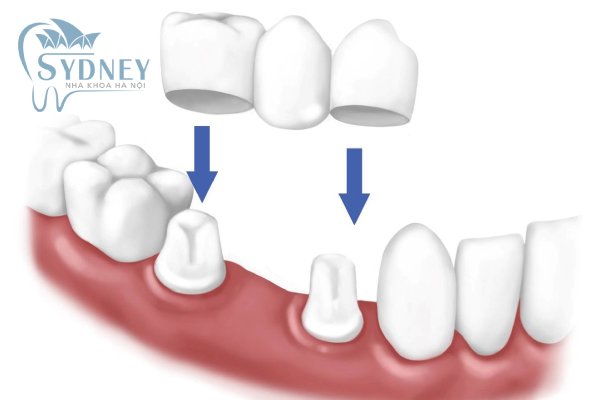 Phương pháp cầu răng sứ hiện nay đang được nhiều người sử dụng