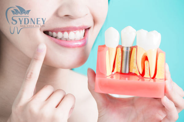 Phương pháp cấy ghép implant là phương pháp an toàn nhất khi mất hay nhiều răng