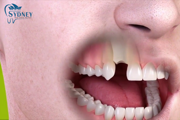 Việc nhổ răng sẽ luôn gây đau đớn hơn việc cấy ghép implant