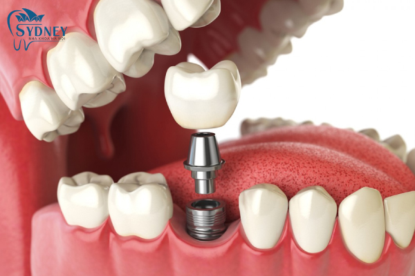 Răng implant có cấu tạo bởi 3 phần chính
