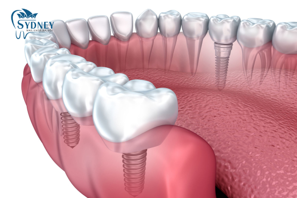 Trồng răng implant liệu có nguy hiểm như bạn nghĩ