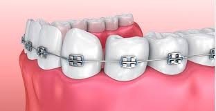 Niềng răng bằng phương pháp mắc cài kim loại tại nha khoa sydney