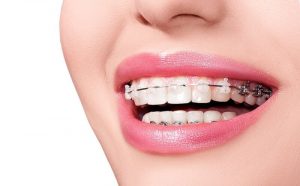 Niềng răng bằng phương pháp mắc cài sứ tại nha khoa sydney