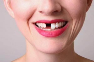 nên trồng răng cửa là điều cấp bách?
