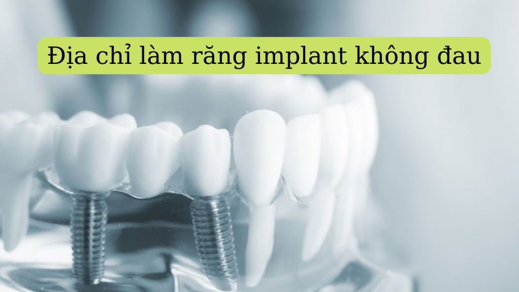 C M Implant C Au Kh Ng I U B N C N Bi T Khi C Y Gh P Implant