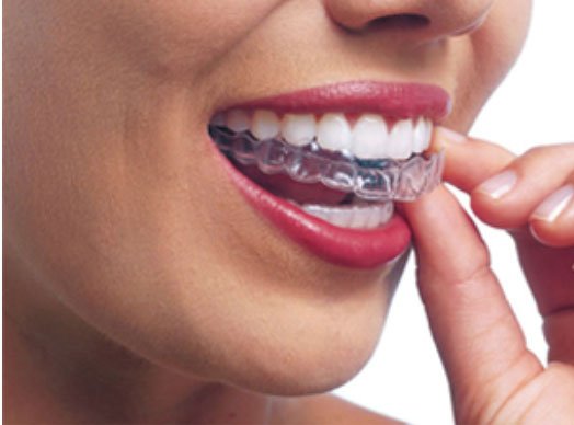 Dịch vụ niềng răng không mắc cài