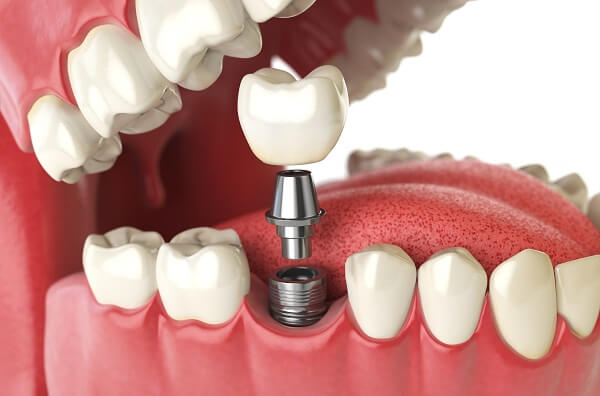 Cấy ghép implant giá rẻ