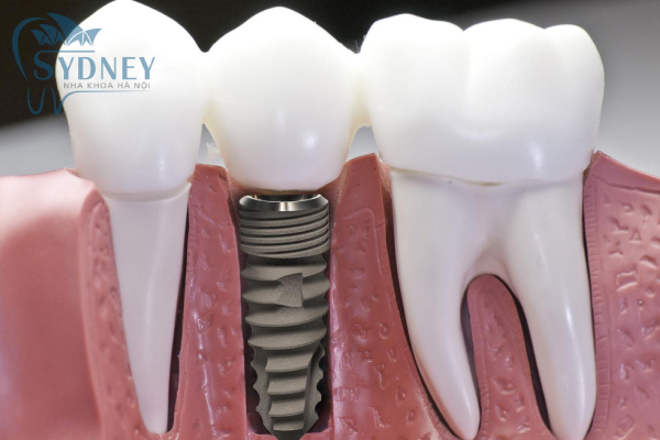 chân trụ implant được làm bằng titan
