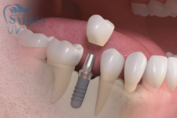 Phương pháp cấy ghép hiện đại