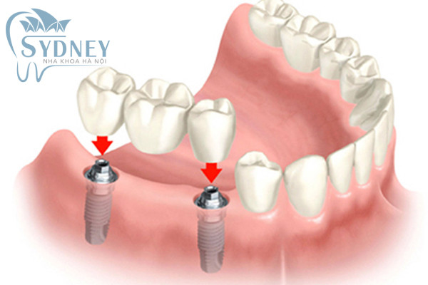 Có thể thay riêng lẻ từng răng mà không ảnh hưởng tới các răng khác