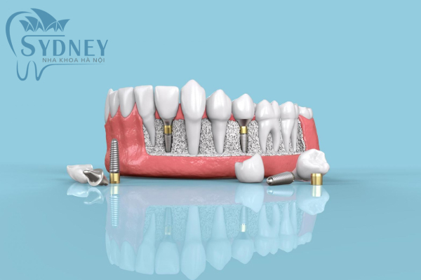 Phương pháp cấy ghép mới