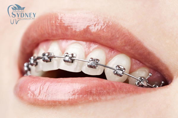 Niềng răng giúp cho răng đều và chắc khỏe hơn