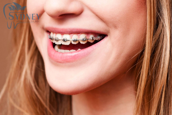 Mắc cài tự khóa tuy hơi cồng kềnh nhưng chắc chắn