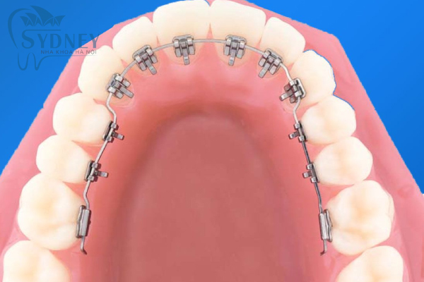 Mắc cài bên trong làm tăng thêm tính thẩm mỹ hơn
