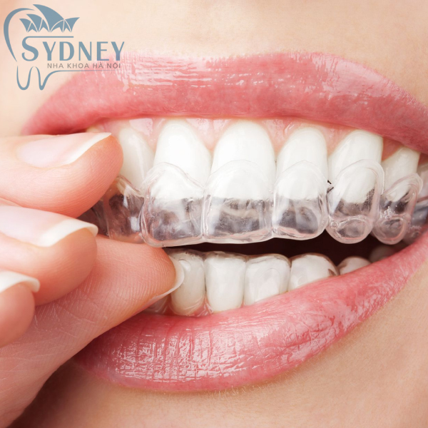 Ưu và nhược điểm của mỗi loại niềng răng khác nhau và cách đưa ra quyết định chọn loại niềng răng phù hợp?
