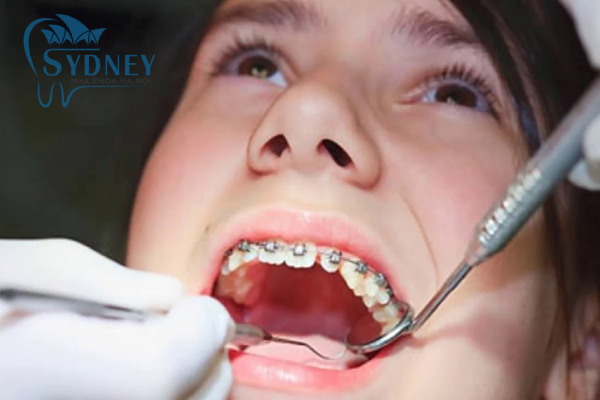 Có 4 giai đoạn khi niềng răng mà bạn phải trải qua