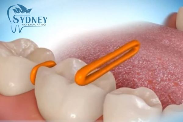 Đặt kẽ thun để có thể niềng răng dễ dàng hơn