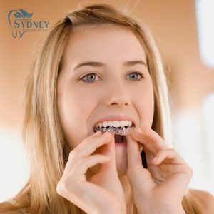 niềng răng không mắc cài của nha khoa sydney