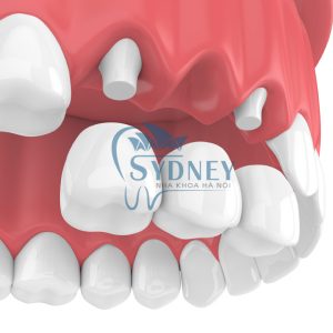 Trồng răng giả có ảnh hưởng gì không?