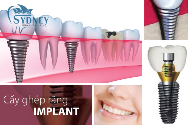 Trồng răng implant mất thời gian bao lâu?