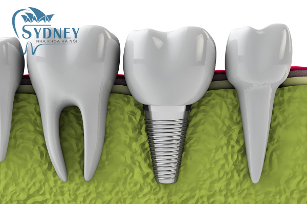 Phương pháp implant có nhiều ưu điểm