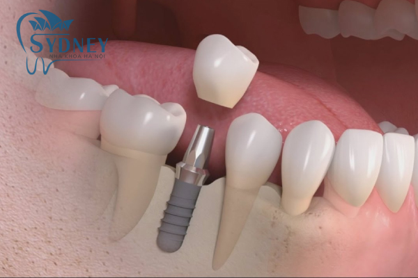 Trồng răng implant là gì?