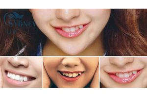 Ý nghĩa của răng khểnh không phải ai cũng biết.