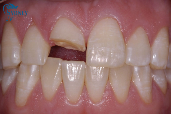 Những người bị mất răng hoặc bị mẻ nên bọc răng sứ thẩm mỹ