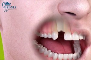 Vì sao bạn nên trồng răng cửa là điều cấp bách?