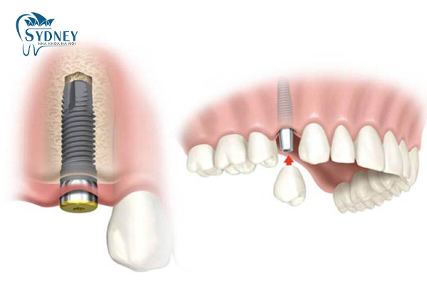 Phương pháp cấy ghép implant có được tốt như bạn nghĩ