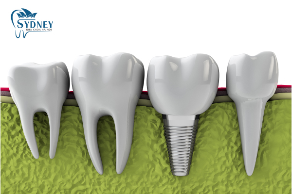 Phương pháp cấy ghép implant là gì?