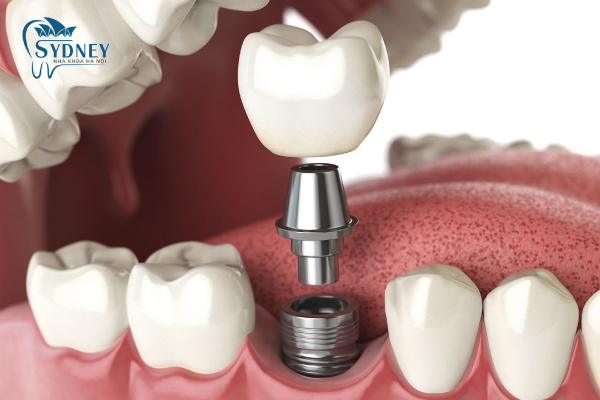 Trồng răng implant tại nha khoa Sydney