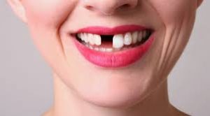 Cấy ghép implant là gì ?
