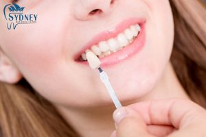 Phương pháp đắp composite để tạo ra răng khểnh
