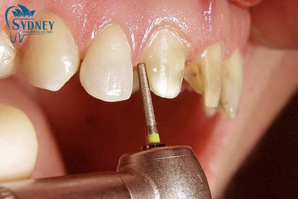 Bọc răng sứ thẩm mỹ có rất nhiều ưu điểm