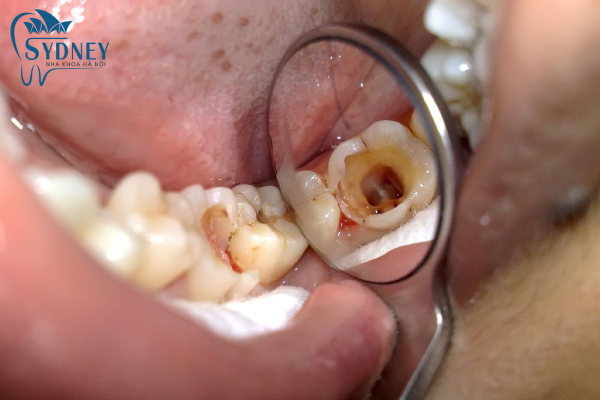 Phương pháp mới không cần mài răng