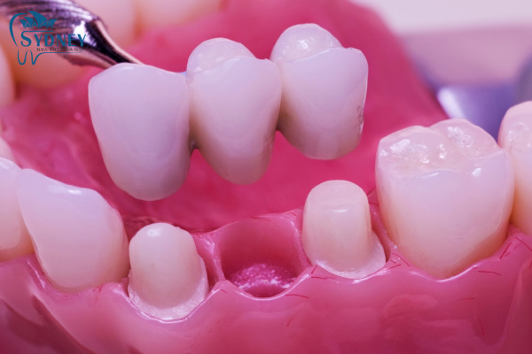 Răng sứ thẩm mỹ khắc phục được nhiều thứ