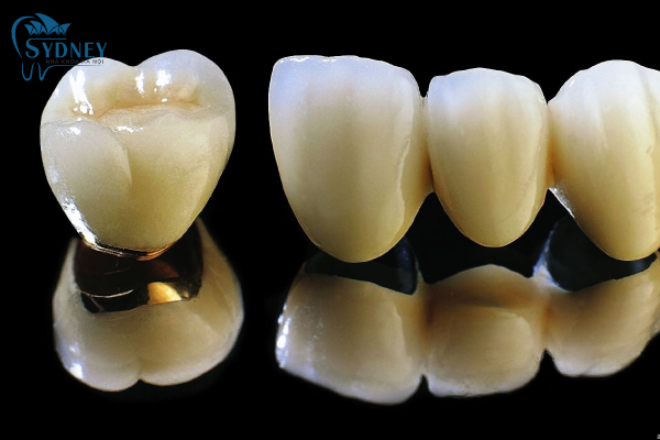Có 2 loại răng sứ thẩm mỹ