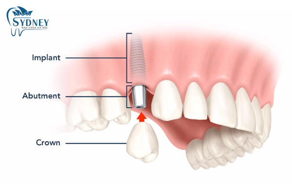 Hãy đến với nha khoa Sydney để cấy ghép răng an toàn