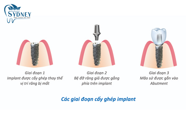 Kỹ thuật cấy ghép implant rất quan trọng