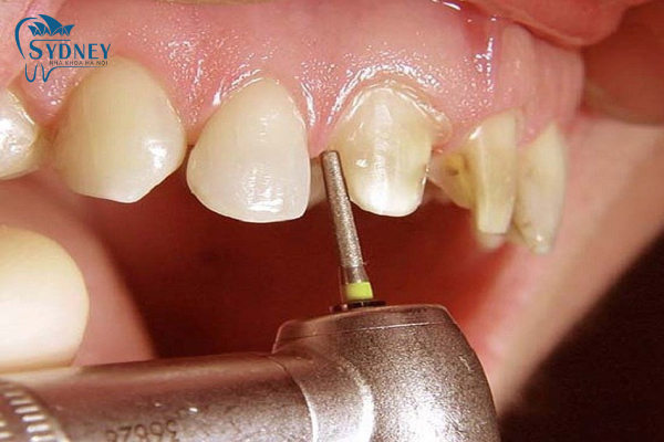 Những người răng thưa nên làm răng thẩm mỹ để khắc phục tình trạng này