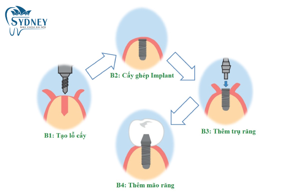 Quy trình cấy ghép implant chuẩn quốc tế tại nha khoa Sydney