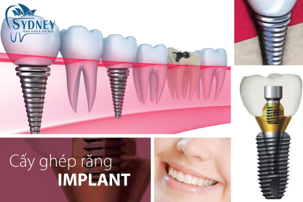 Các yếu tố để đánh giá quy trình trồng răng an toàn