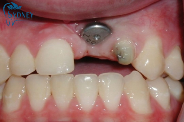 Cấy ghép trụ implant vào xương hàm