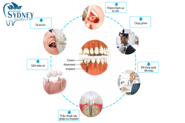 Quy trình cấy ghép răng implant