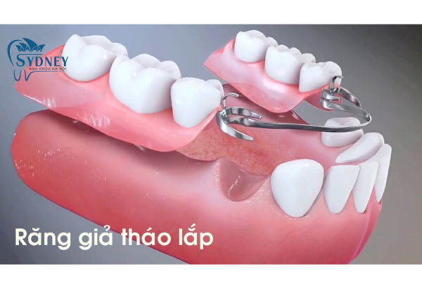Răng giả tháo lắp có rất nhiều ưu điểm