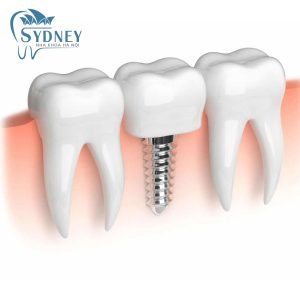 Trồng răng implant có nguy hiểm hay không?