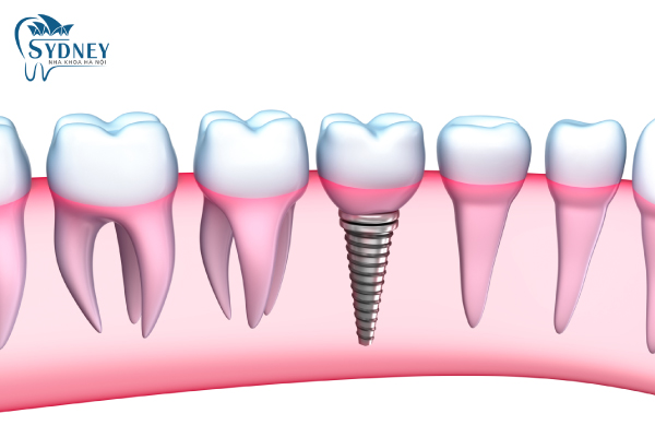 Răng implant có cấu tạo ê phần